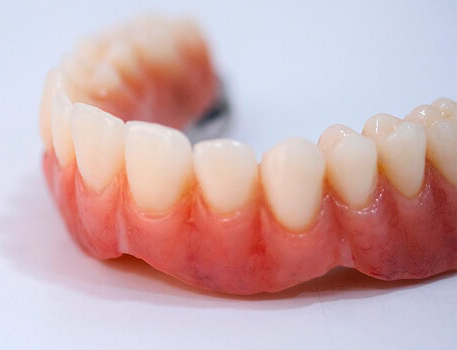 prótesis dental fija