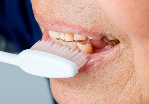 Desgaste dental